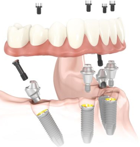 all on four dental implants san antonio