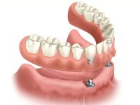 implant overdentures san antonio 1