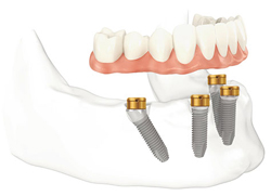 implant overdentures san antonio 3