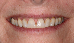 digital smile design san antonio 1