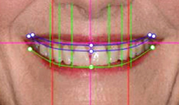 digital smile design san antonio 2