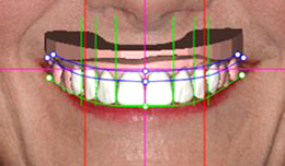 digital smile design san antonio 3