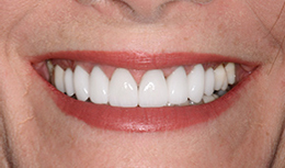 digital smile design san antonio 4