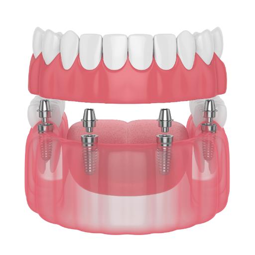 All on 4 implants