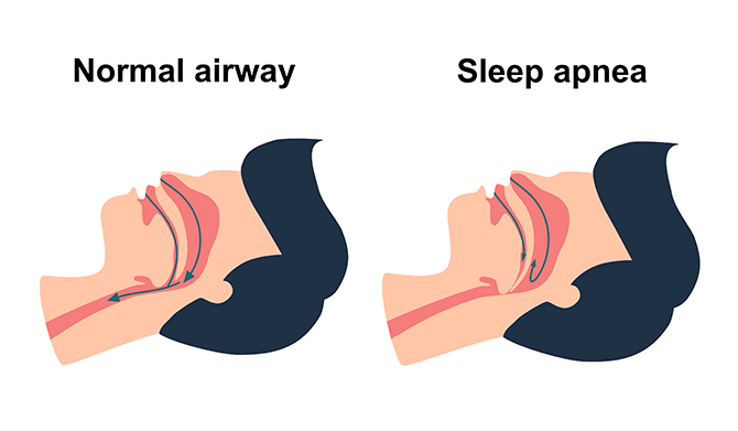 Normal Airway vs Sleep Apnea