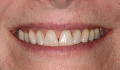digital smile design san antonio 1