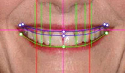 digital smile design san antonio 2