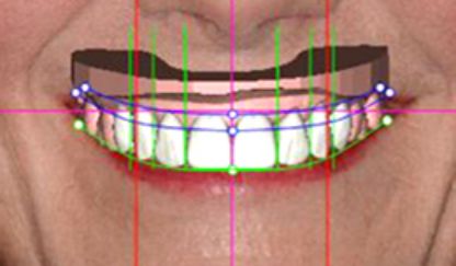 digital smile design san antonio 3