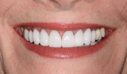 digital smile design san antonio 4