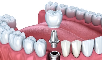 implant diagram